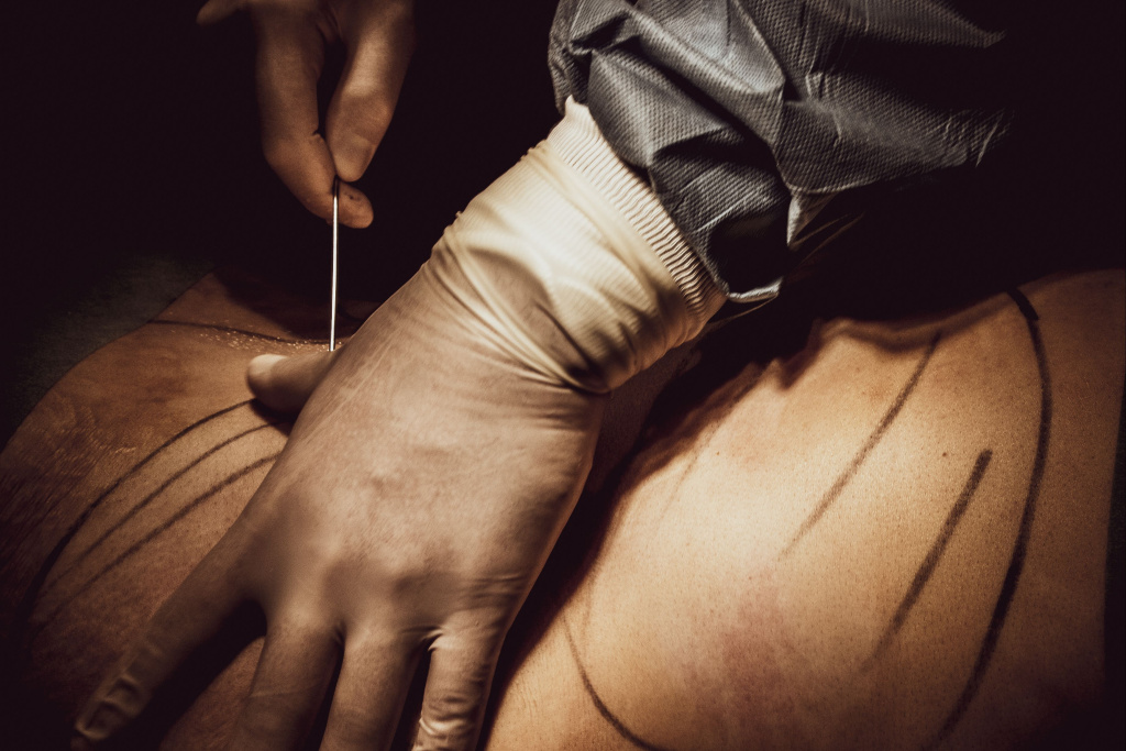 Пластическая хирургия живота