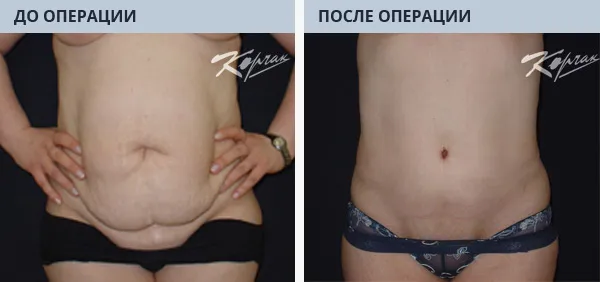 Секс После Операции Грыжи На Животе Секс После Операции Грыжи На Животе
