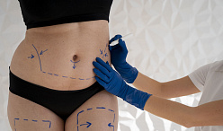 Плоский живот без разрезов: как устранить диастаз прямых мышц живота?